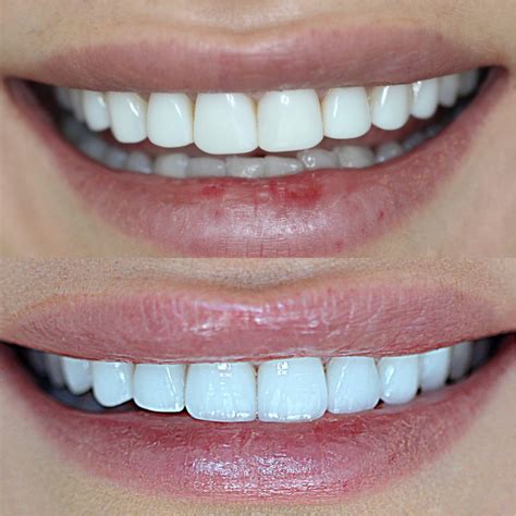composite teeth veneers|what are composite teeth.